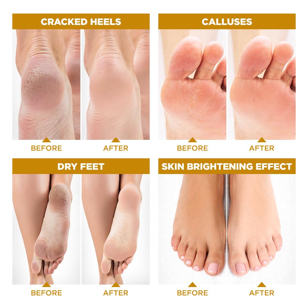 Lavinso Honey Feet Peeling Mask for Dry Cracked Feet - 4 Pack - with Kojic Acid Skin Brightening Effect - Exfoliating Dead Skin and Calluses - Foot Peel Mask for Baby Soft Feet