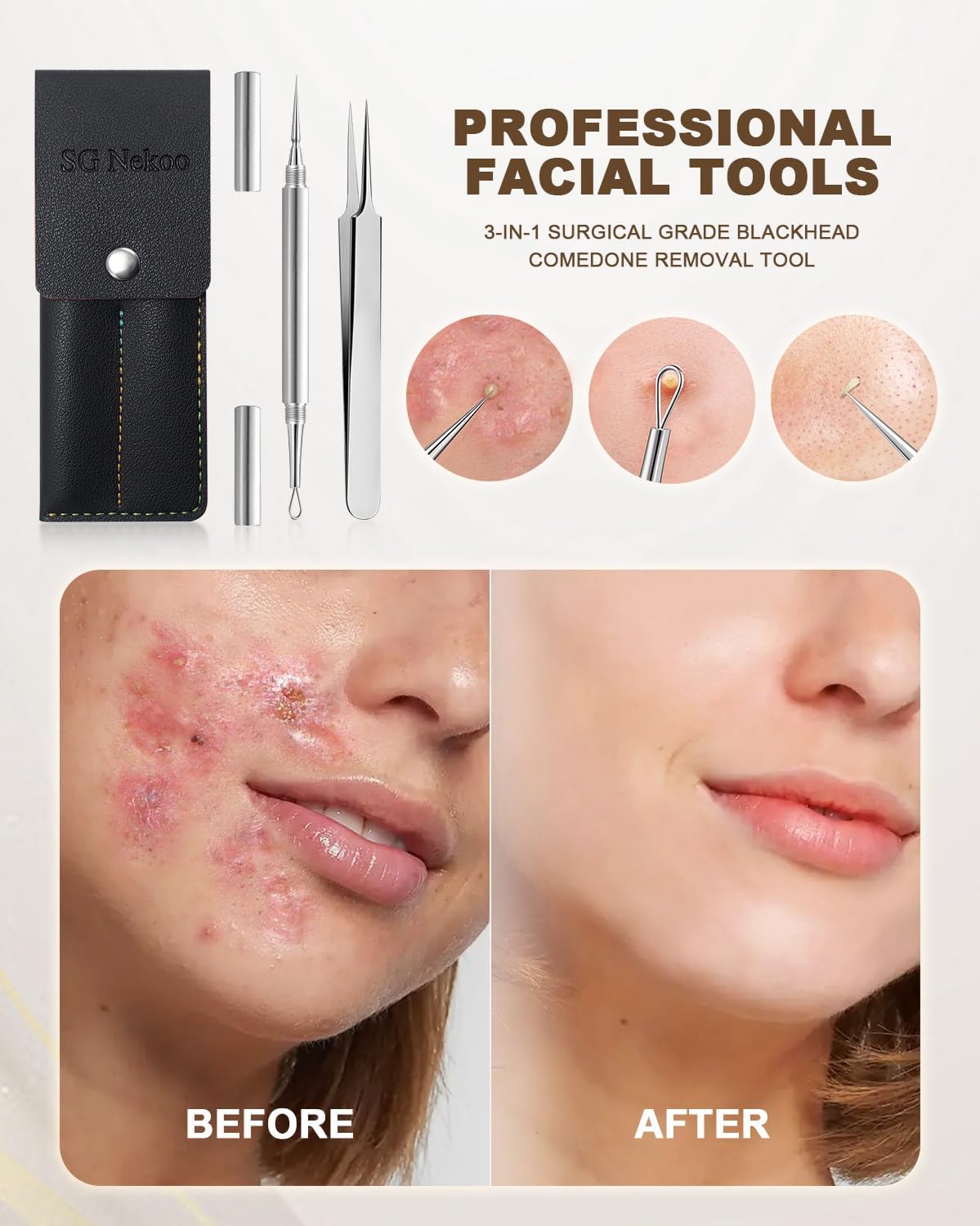 SGNEKOO Professional Facial Milia Removal Tool and Whitehead Extractor,Titanium Alloy Double Ended Needle and Steel Tweezers Kit,Blackhead,Blemish,Zit and Pimple Acne Remover Popper (Stainless Silver)